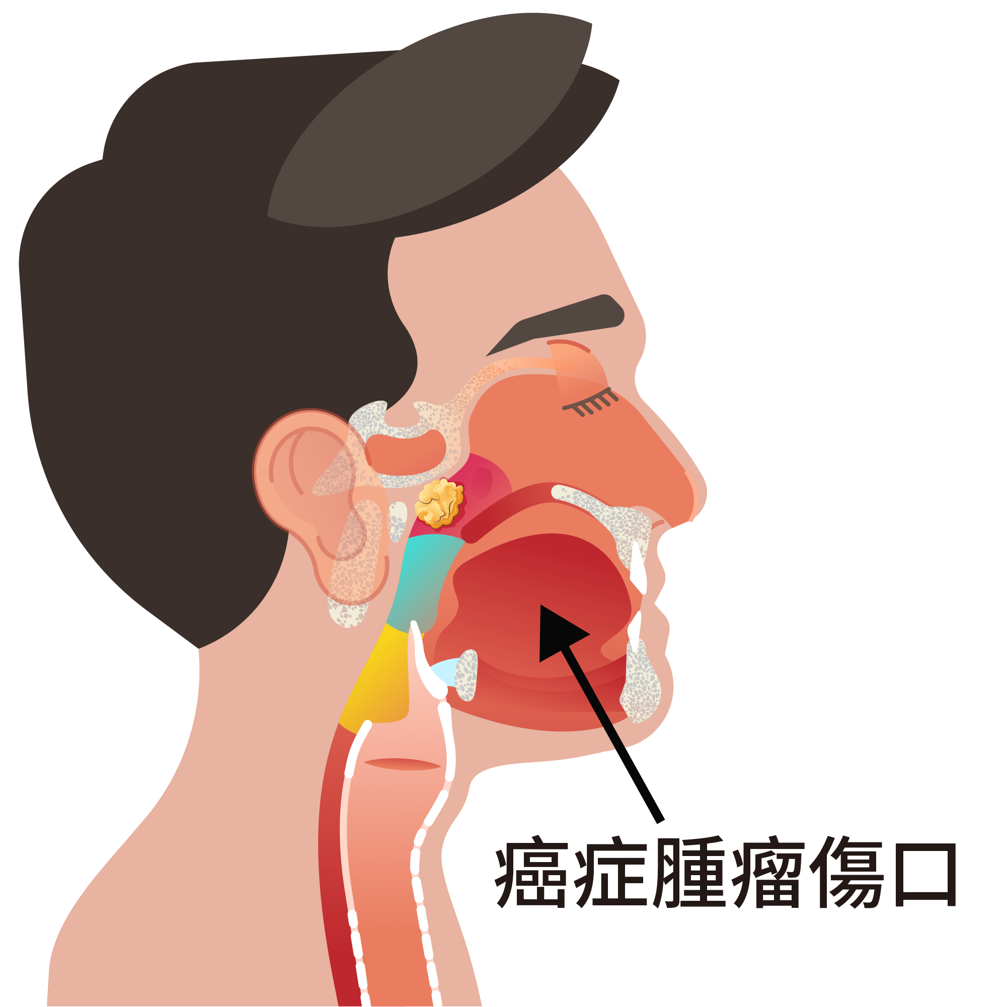 癌症傷口